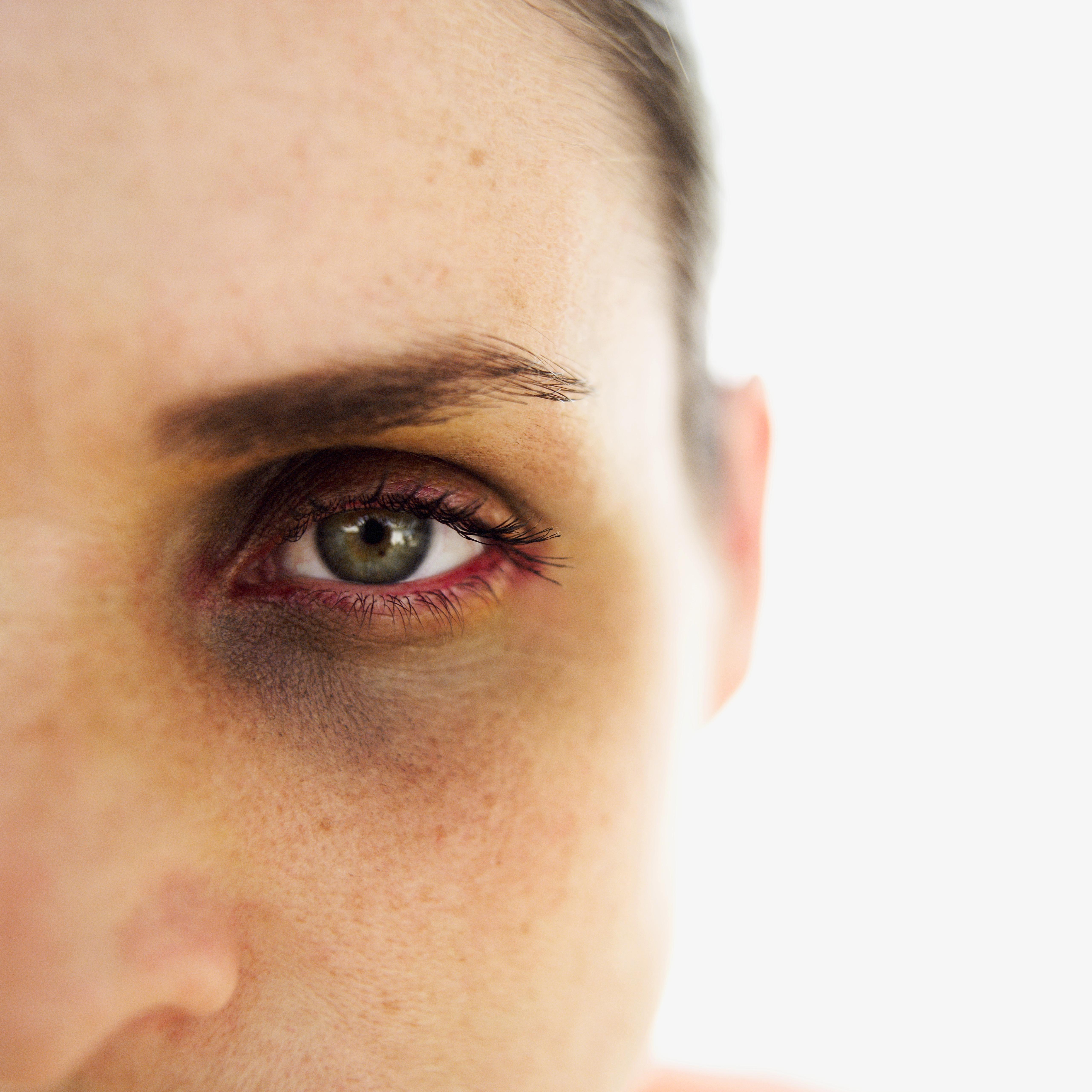 close-up of a woman with a black eye