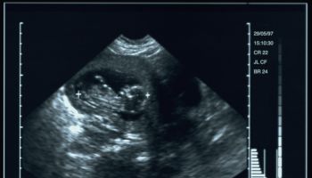 ultrasound image of a human fetus