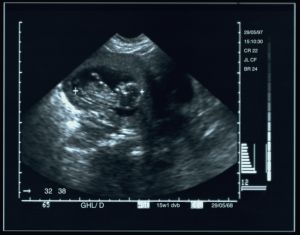 ultrasound image of a human fetus